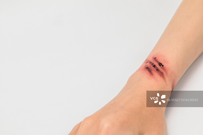 手部伤口图片素材