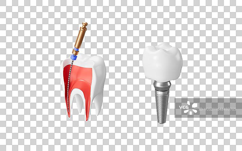 人类牙齿根管治疗和种牙模型3D渲染图片素材