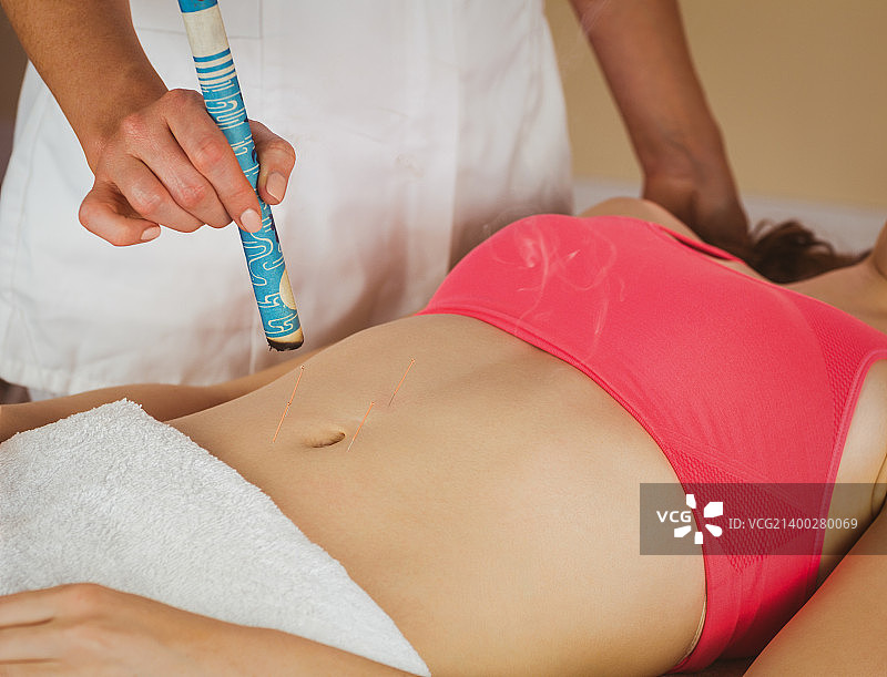 年轻女人在治疗室接受针灸治疗图片素材