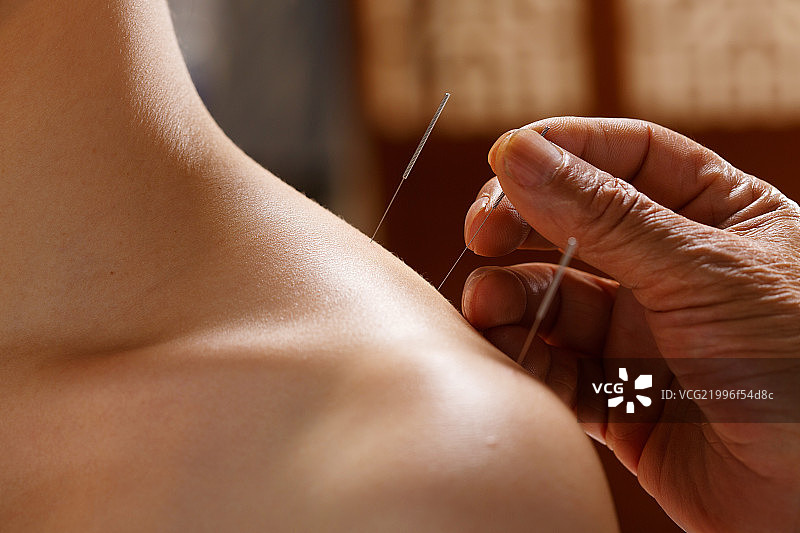 中医针灸图片素材