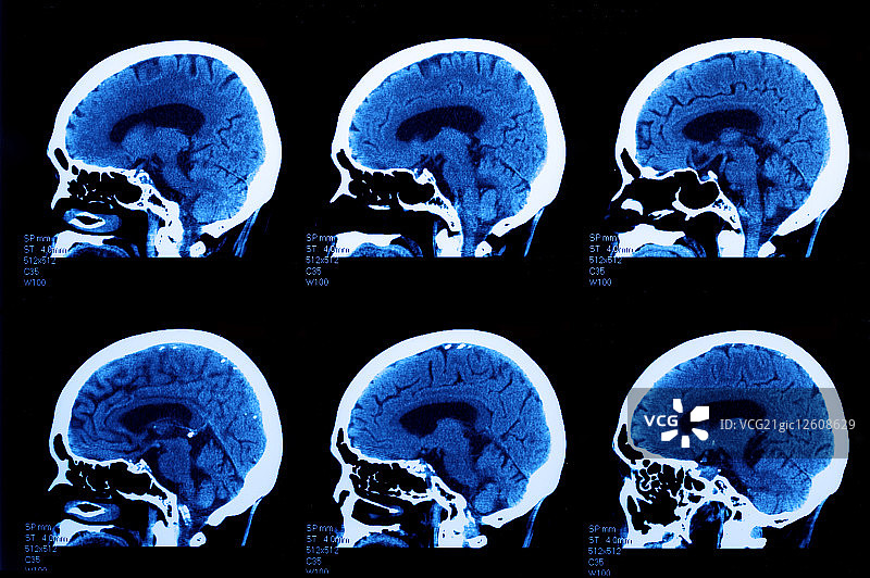 人物头部,断层扫描图片素材