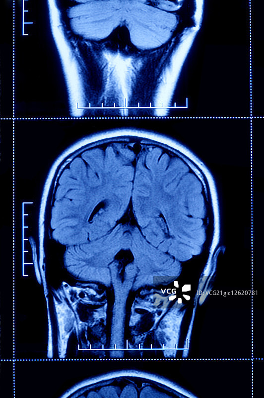 核磁共振扫描,脑部图片素材