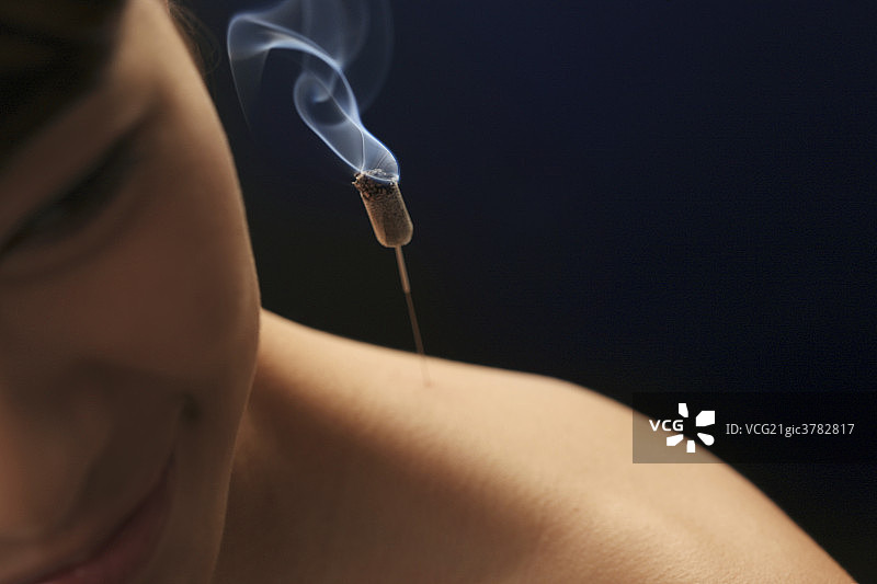 中医针灸图片素材