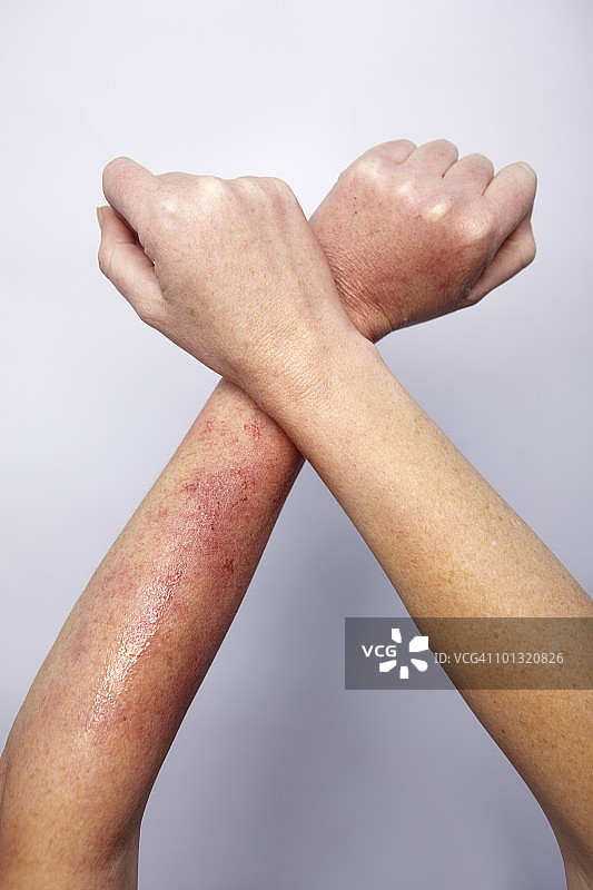 手臂上的皮疹，双臂交叉图片素材