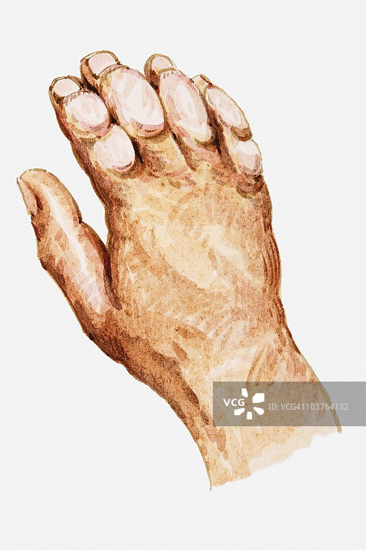 显示冻伤的手部插画图片素材