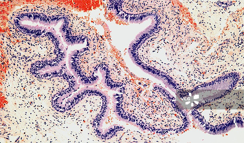 鼻息肉，光学显微照片图片素材
