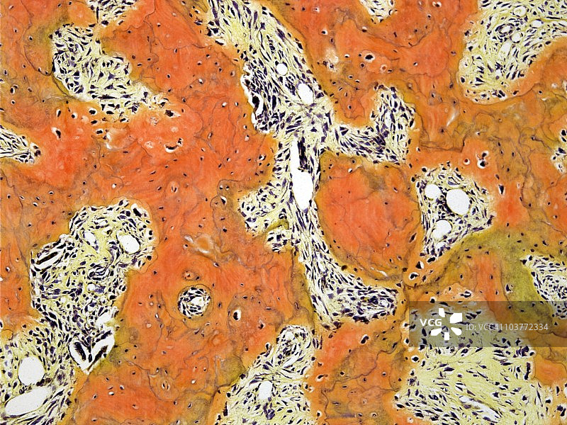 佩吉特病显微照片图片素材