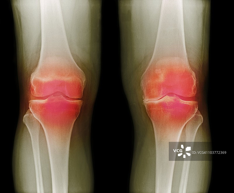 关节炎膝盖X光片图片素材