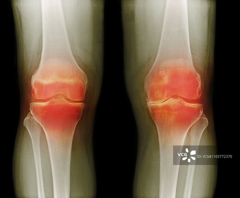 关节炎膝盖X光片图片素材