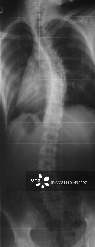 人体脊柱X光片图片素材