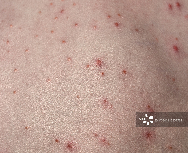 儿童背部的毛囊炎（理发师的痒）图片素材