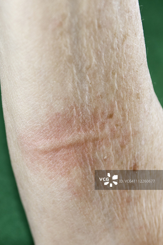 皮肤荨麻疹或皮疹图片素材