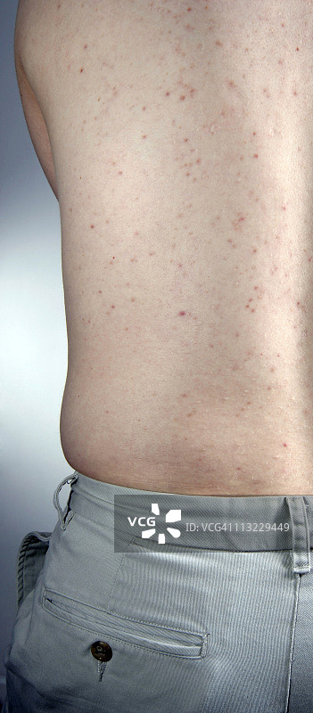 男性背部的痤疮图片素材