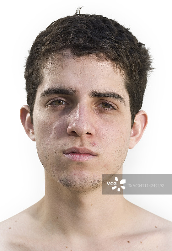 十九岁的痤疮图片素材