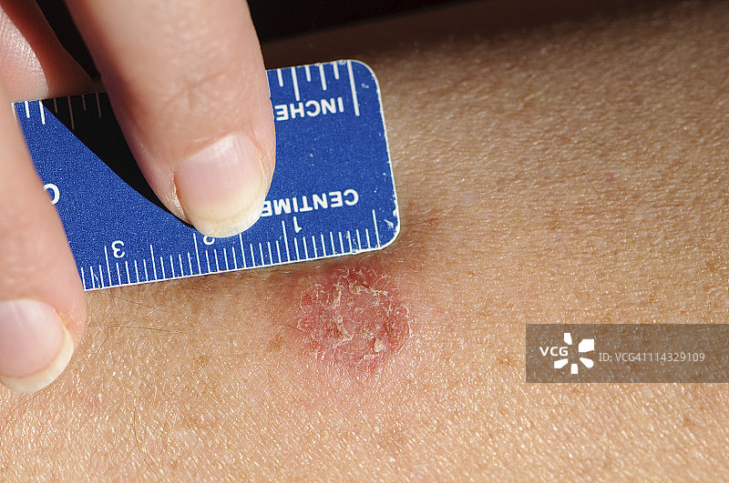 体癣感染（环癣）图片素材