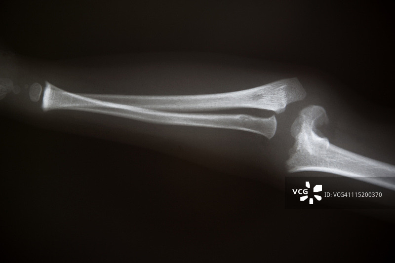 手臂骨折图片素材