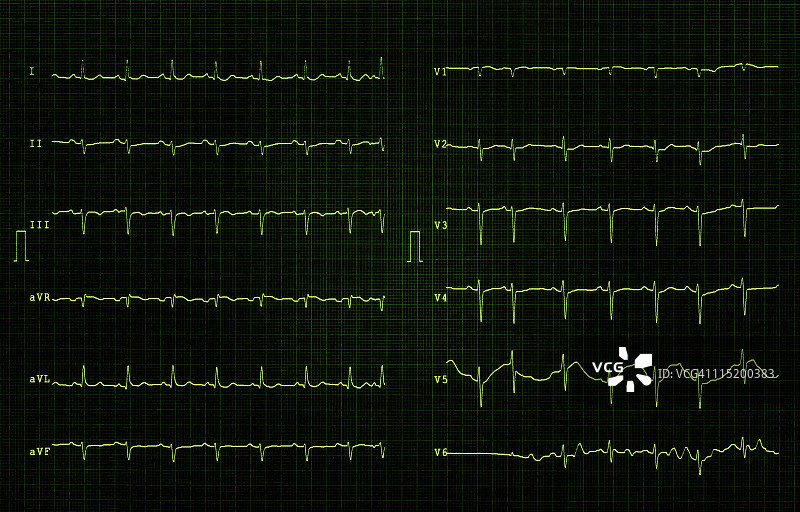 心电图XXL图片素材