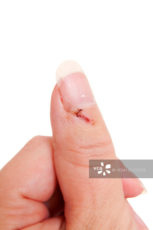 第6天：拇指受伤的白人女性系列图片素材