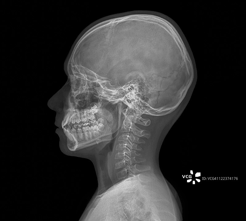 正常儿童头部X光片图片素材