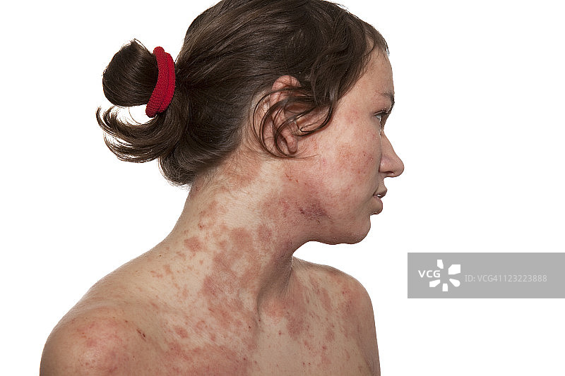 特应性皮炎图片素材