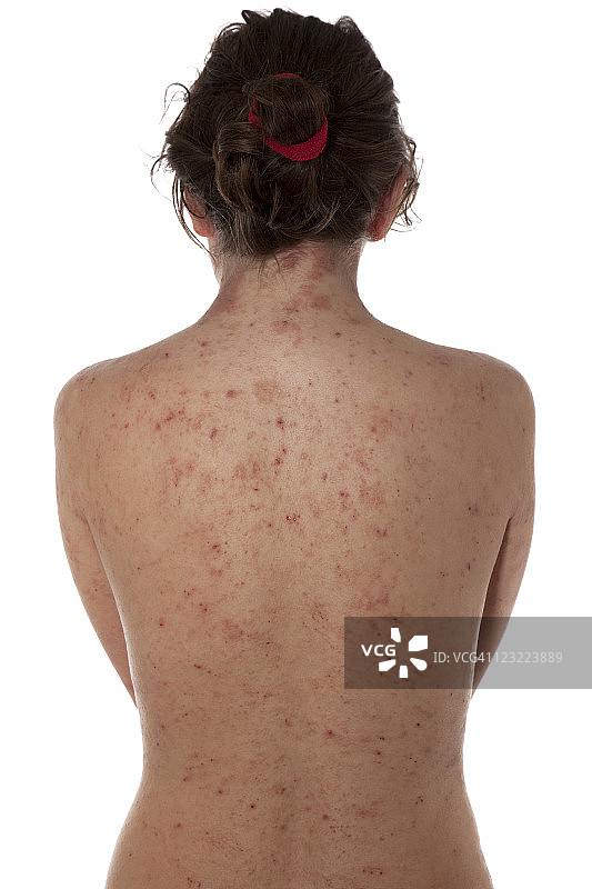 裸背患有特应性皮炎的女人图片素材