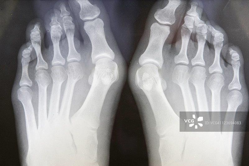 有拇囊炎的脚部X光片图片素材