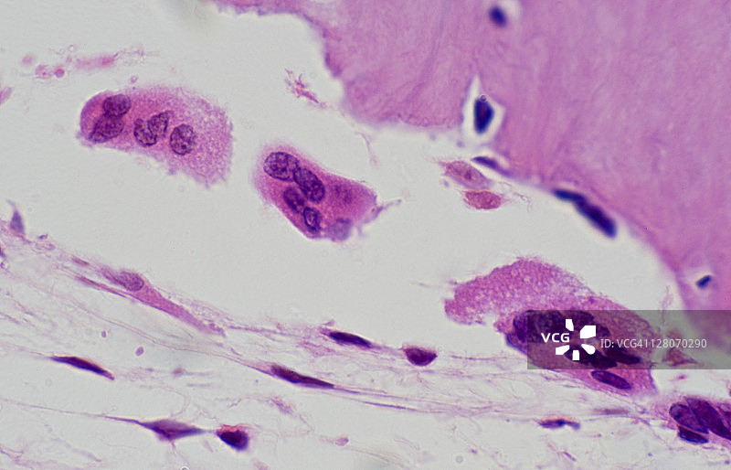 破骨细胞（骨破坏细胞）和人松质骨的骨吸收（放大倍数x250）图片素材