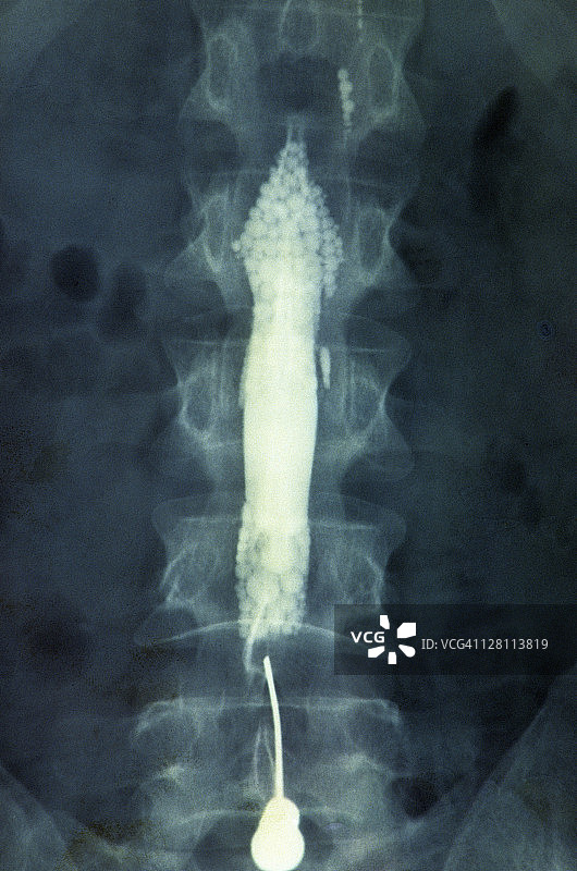 脊髓造影显示脊髓下方的针头和蛛网膜下腔。不透射线的染料勾勒出脊髓下方和脊柱内的蛛网膜下腔。用于诊断椎间盘突出和其他异常。黑点是肠道中的气体。图片素材