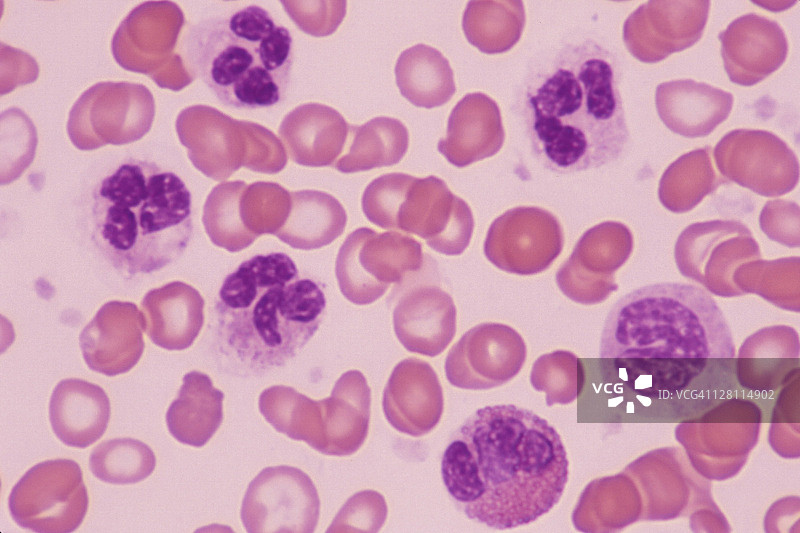 血液：急性炎症、白细胞增多，嗜中性粒细胞、嗜酸性粒细胞和单核细胞，大量白细胞，400倍图片素材
