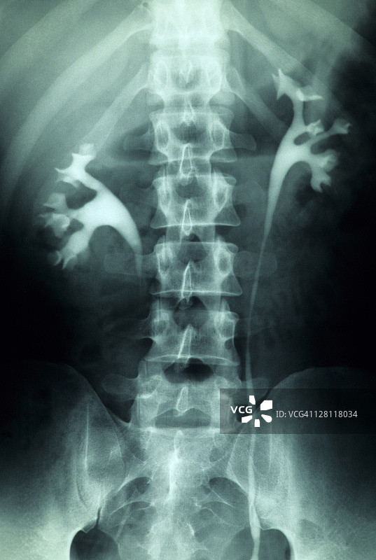 X光片显示肾脏和泌尿道图片素材