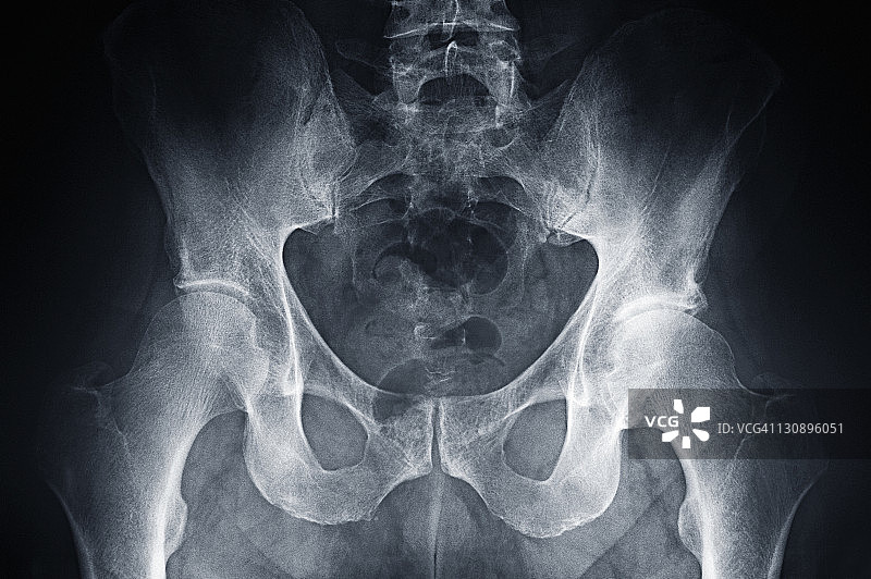 中年男人臀部的X光特写图片素材