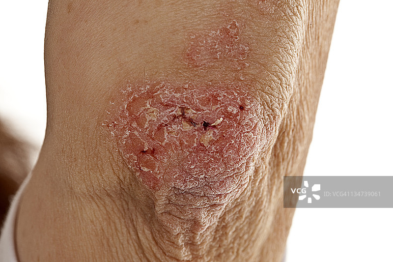 老年人手肘牛皮癣图片素材