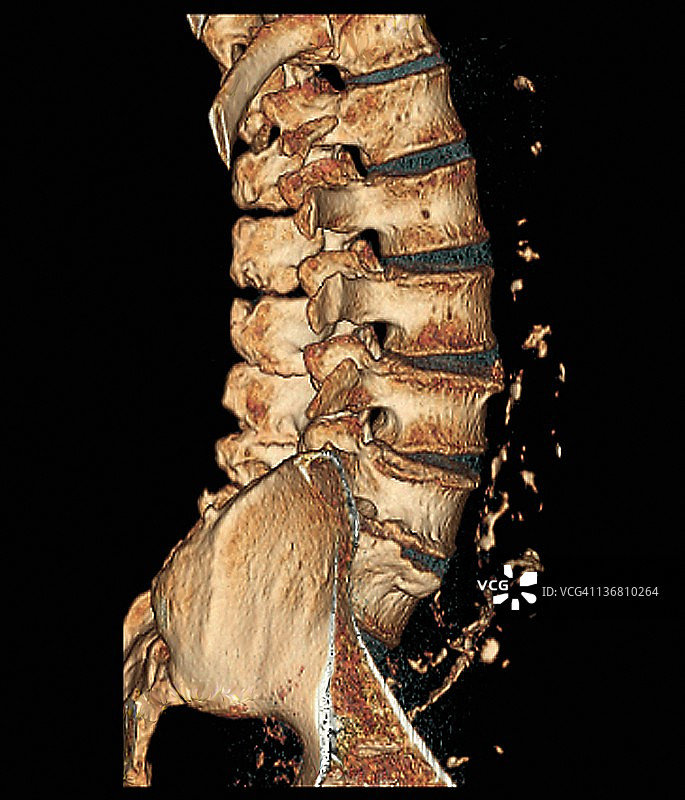 椎间盘退行性疾病3D CT扫描图片素材