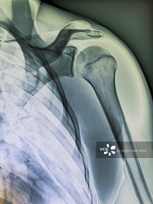 正常肩部X光片图片素材