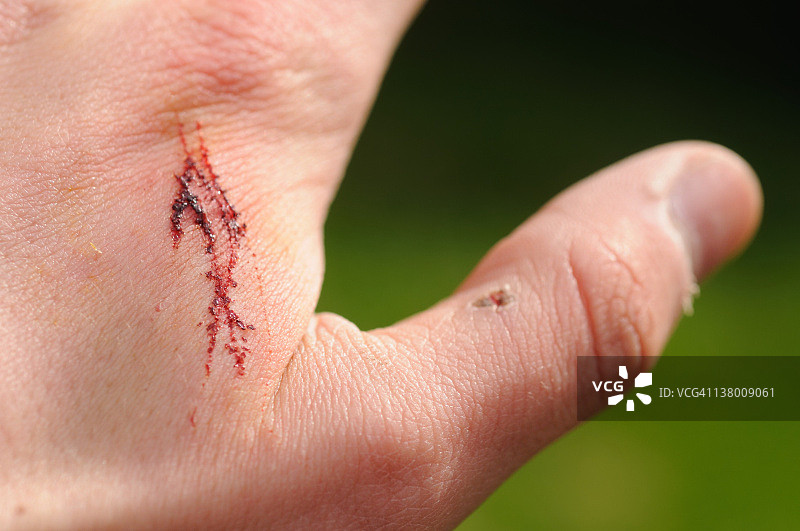 手上的疤痕图片素材