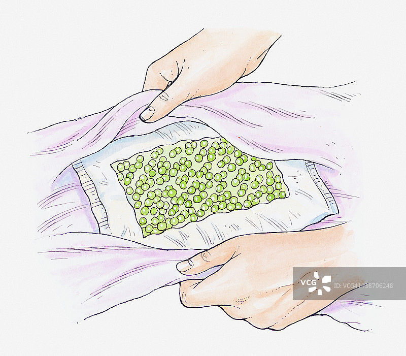 用毛巾包裹冷冻豌豆袋用作冷敷的插画图片素材