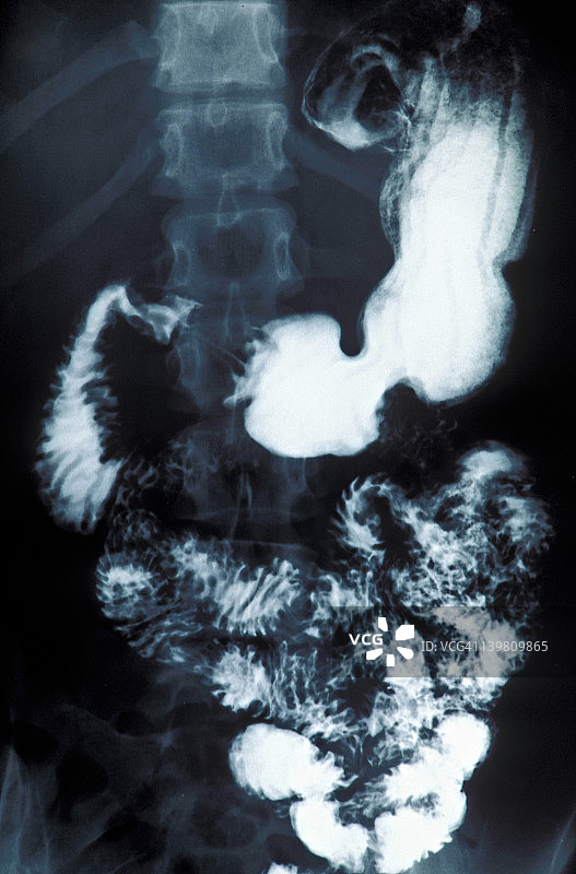 X光，上消化道（使用钡），胃，小肠，呈羽毛状，幽门，蠕动波图片素材