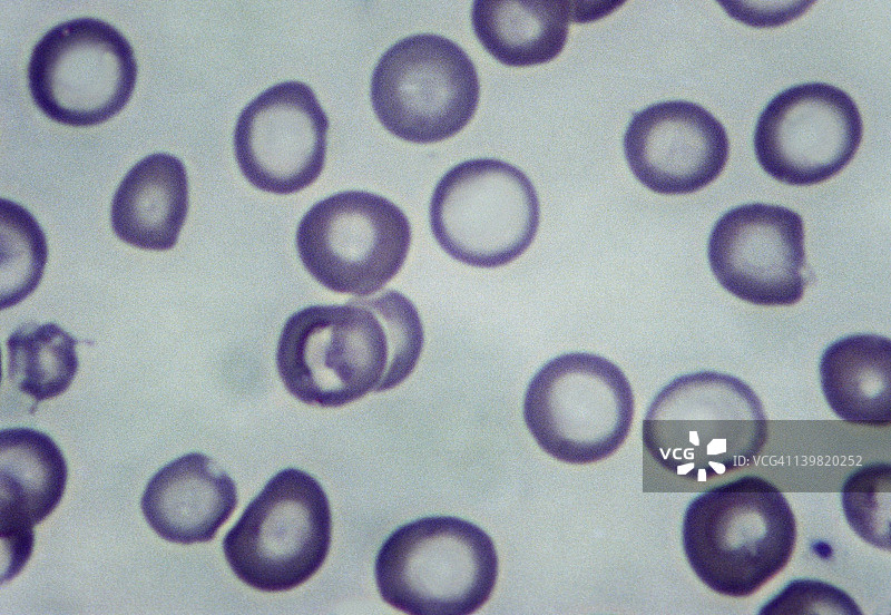 缺铁性贫血，低色素性红细胞图片素材
