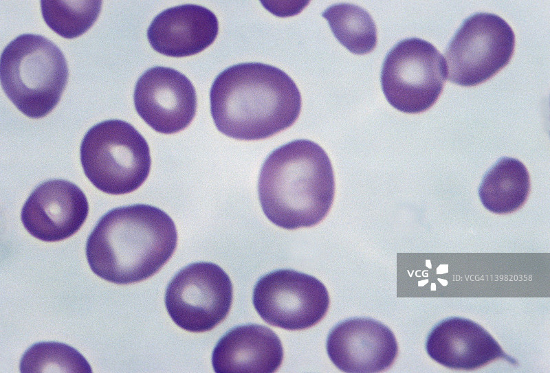 恶性贫血：巨幼红细胞与维生素B12缺乏图片素材