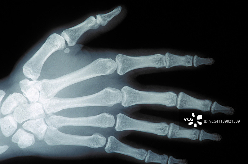 成人右手X光片：腕骨、掌骨、指骨、桡尺骨和籽骨图片素材