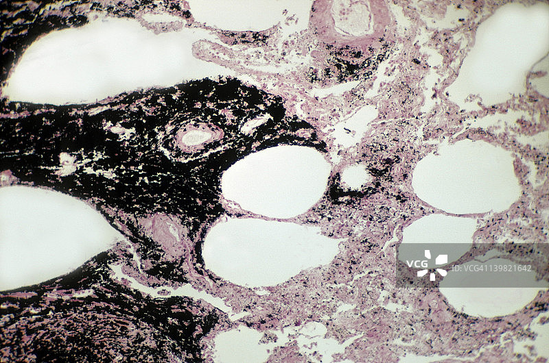 煤尘沉着病：吸入煤尘引起的肺部疾病，250倍放大图片素材