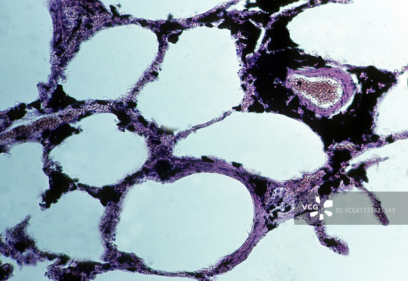 煤尘沉着病：吸入煤尘颗粒引起的肺部疾病，50倍放大，35毫米。注意肺组织中大量煤尘颗粒使肺部呈现黑色，导致弥漫性纤维化。图片素材