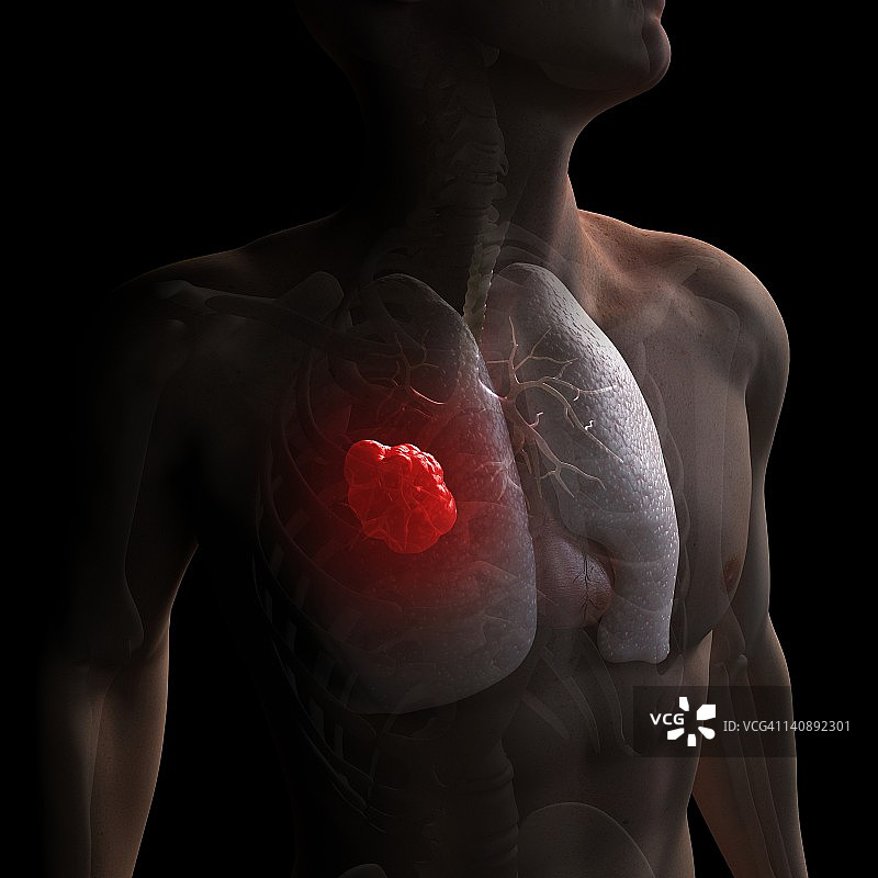 肺癌艺术作品图片素材