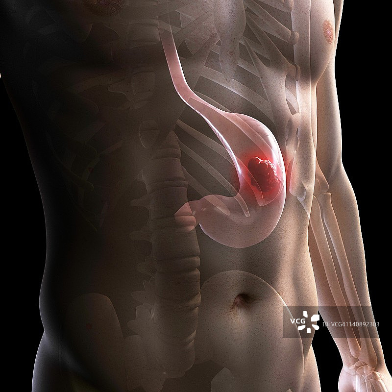 胃癌医学插图图片素材