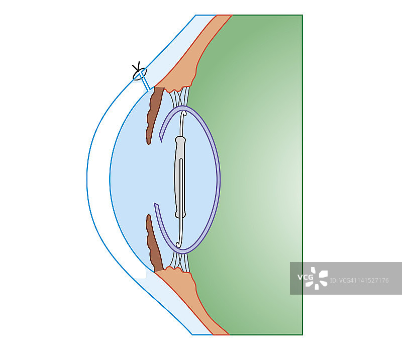 白内障手术的生物医学横截面图图片素材