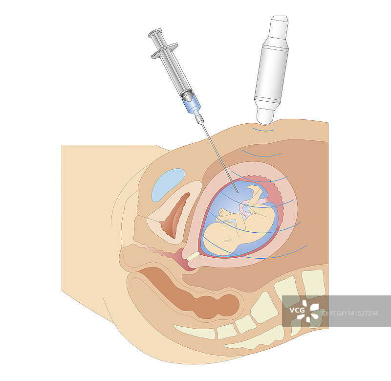 羊膜穿刺术生物医学剖面图图片素材