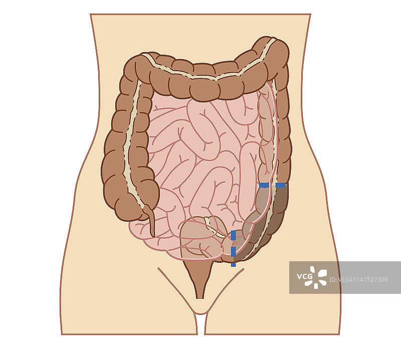 部分结肠切除术的生物医学横截面图图片素材