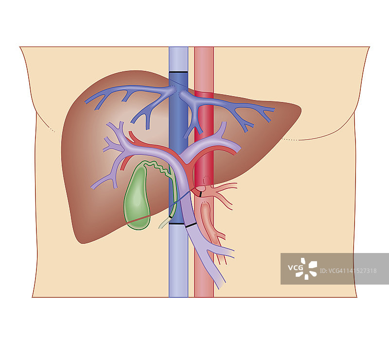 肝移植手术的横截面生物医学图示图片素材