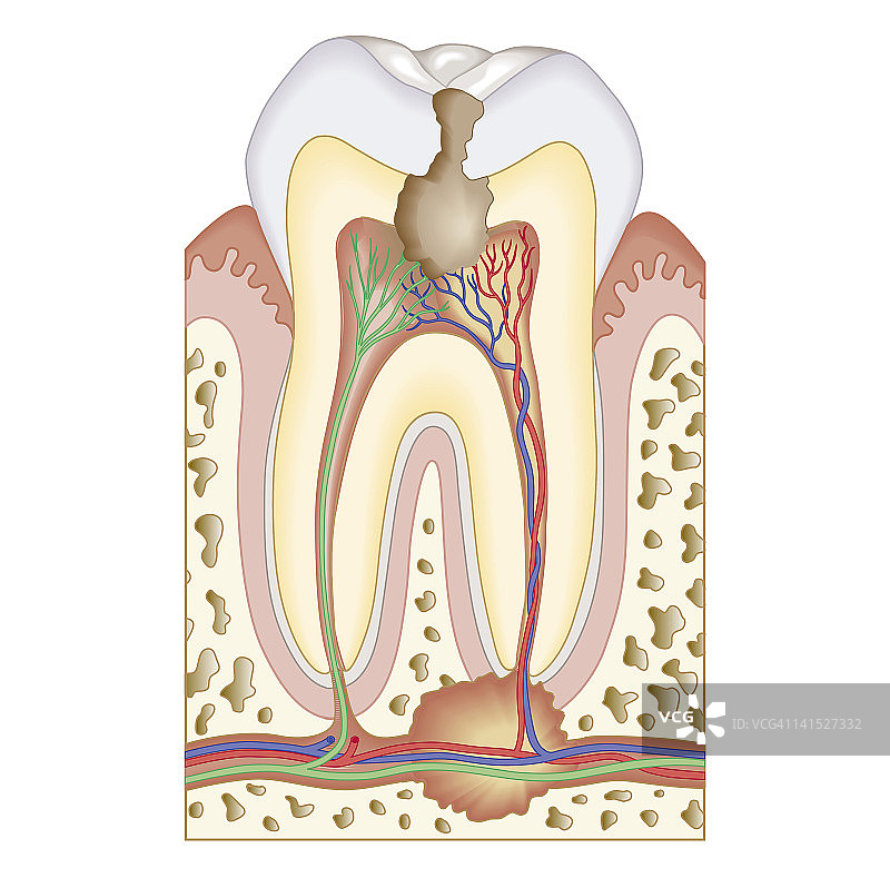 臼齿中牙髓和根部脓肿的生物医学截面图图片素材
