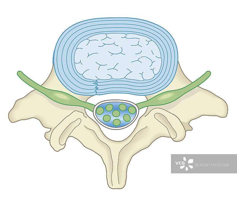 术后腰椎间盘切除术的生物医学横截面图图片素材